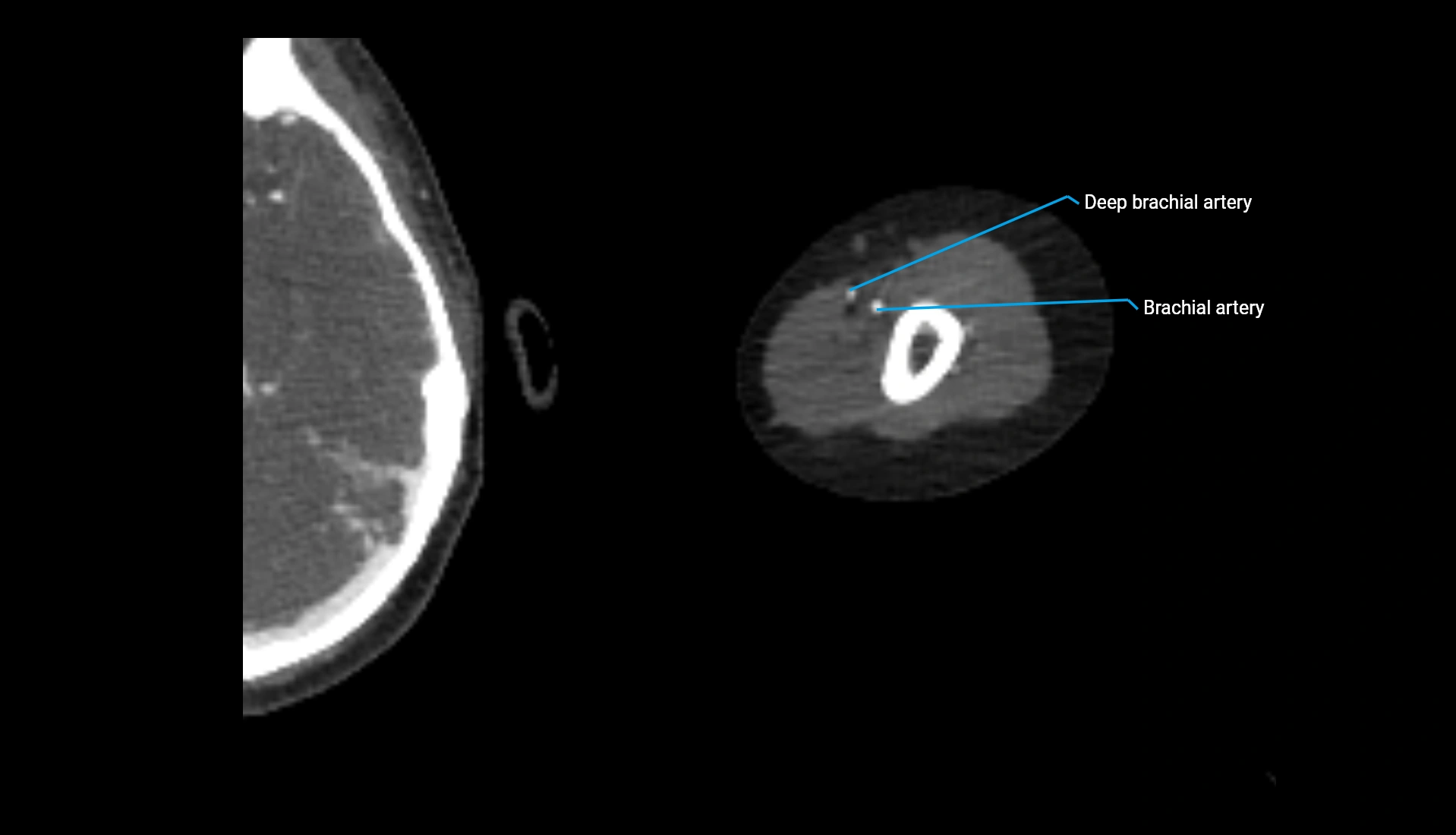 CTA upper limb axial cross sectional anatomy labelled image 253 (2).webp